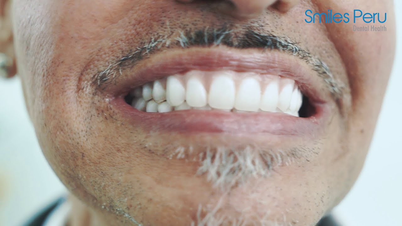 Testimonial Full Mouth Implants | All on six | Smiles Peru