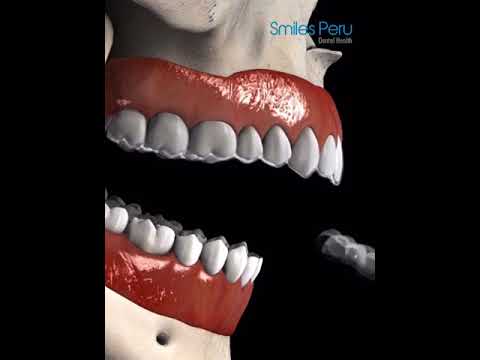 Invisalign Sobremordida Anterior - Smiles Peru