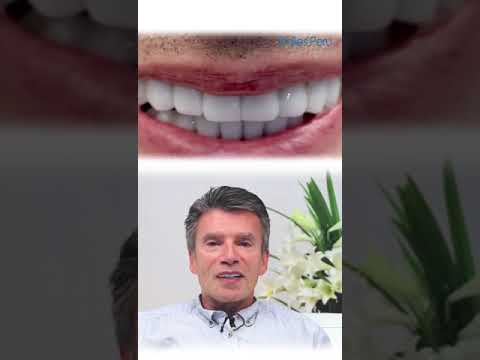 Oral Rehabilitation at Smiles Peru