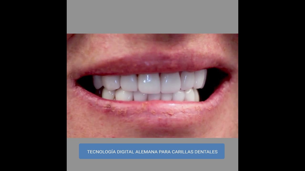 Smiles Peru Veneers / Carillas de Porcelana