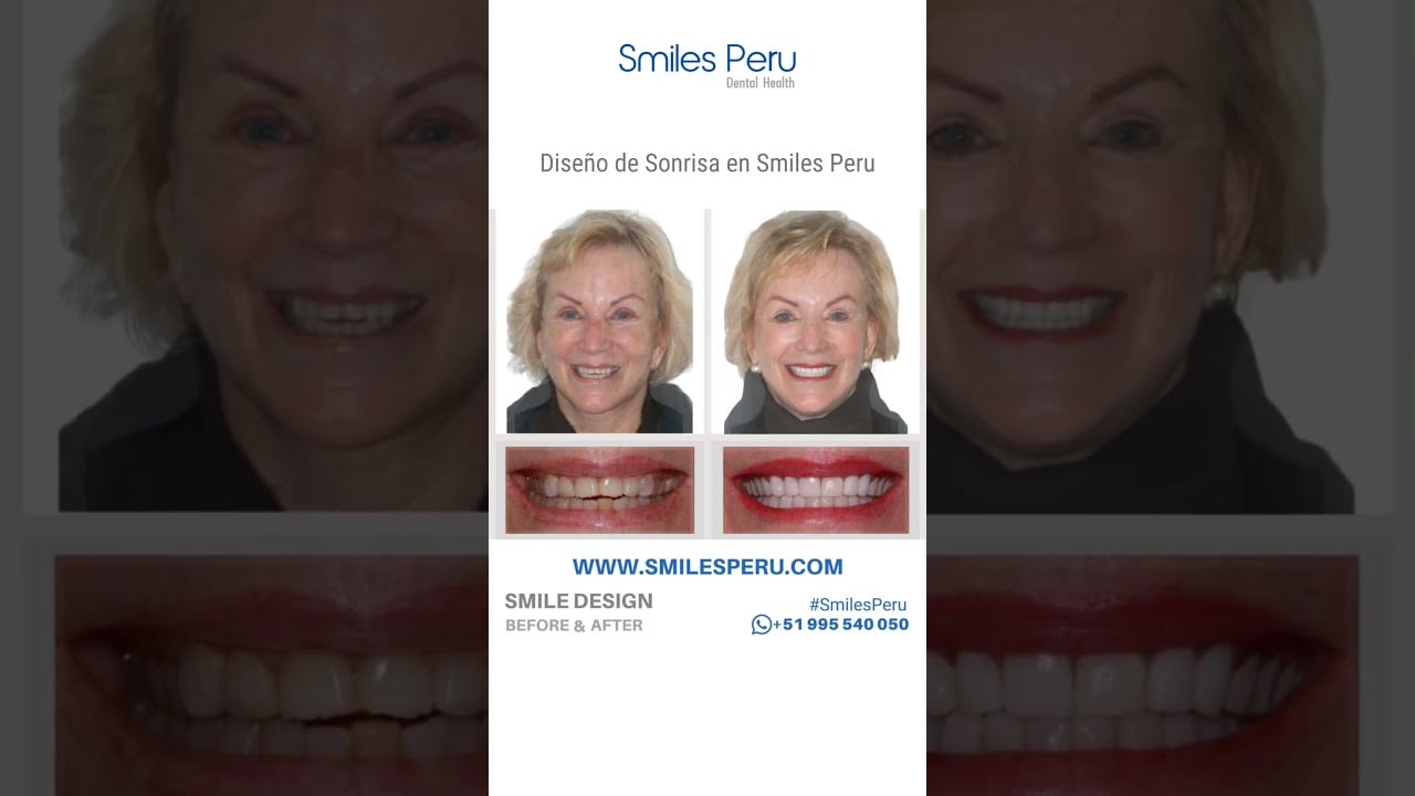 Transformaciones de Diseño de Sonrisa – Antes y Después | Smiles Peru