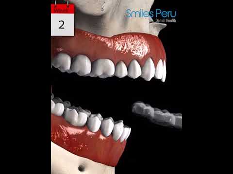 Invisalign Mordida Cruzada Anterior - Smiles Peru