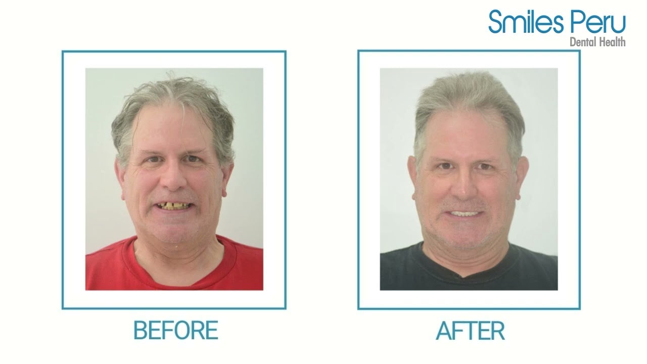 Smiles Peru Video Testimonial and Review. Dentist, Miraflores, Lima, Peru.