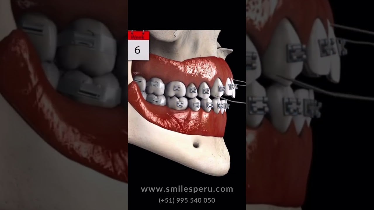 Brackets para mordida abierta/ Braces for an Open Bite
