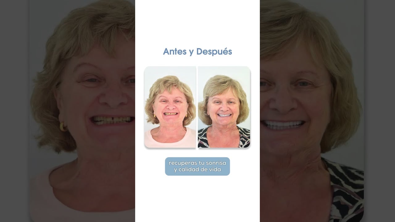 Implantes Dentales en Smiles Peru