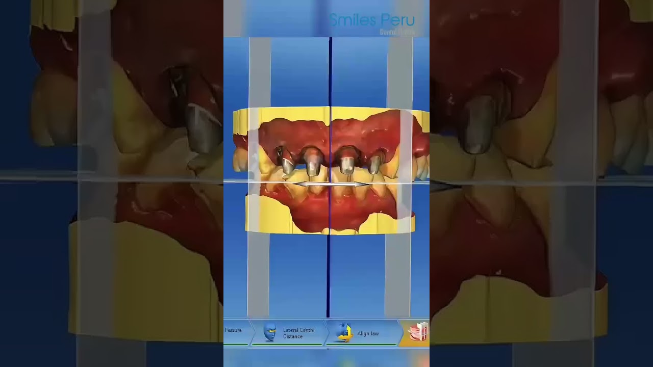 Smiles Peru | Dental Implants, Oral Rehabilitation & Cosmetic Dentistry in Lima