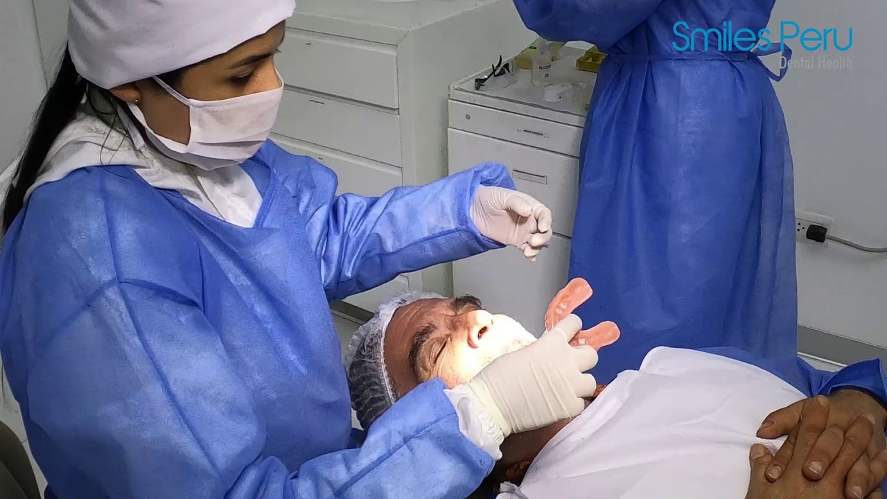 Smiles Peru: Implant Supported Removable Prosthesis