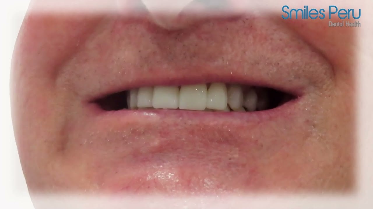 Woody Testimonial Review | Smiles Peru