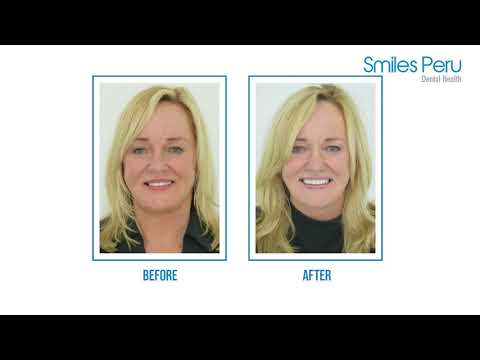 Smiles Peru Dental Review & Testimonial - Sharon