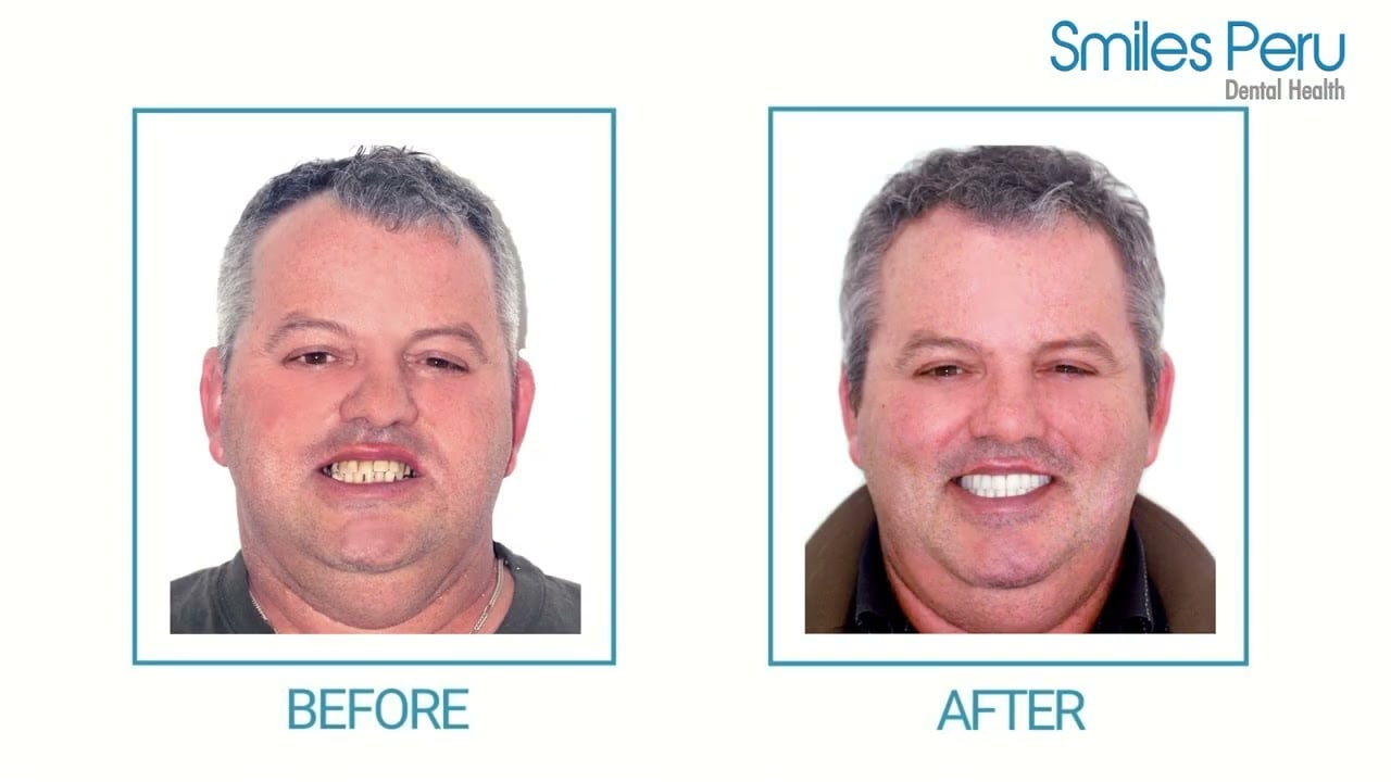 Tomasoni’s Experience at Smiles Peru