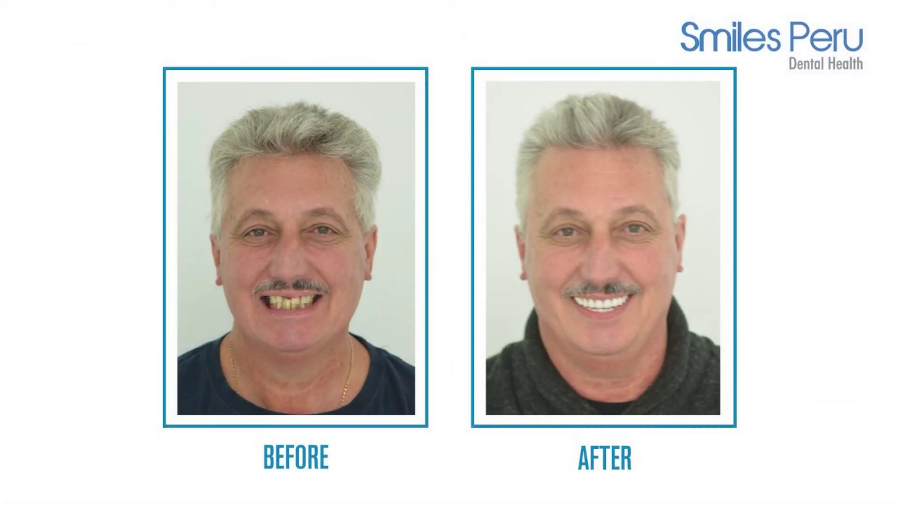 Full Mouth Dental Implants at Smiles Peru