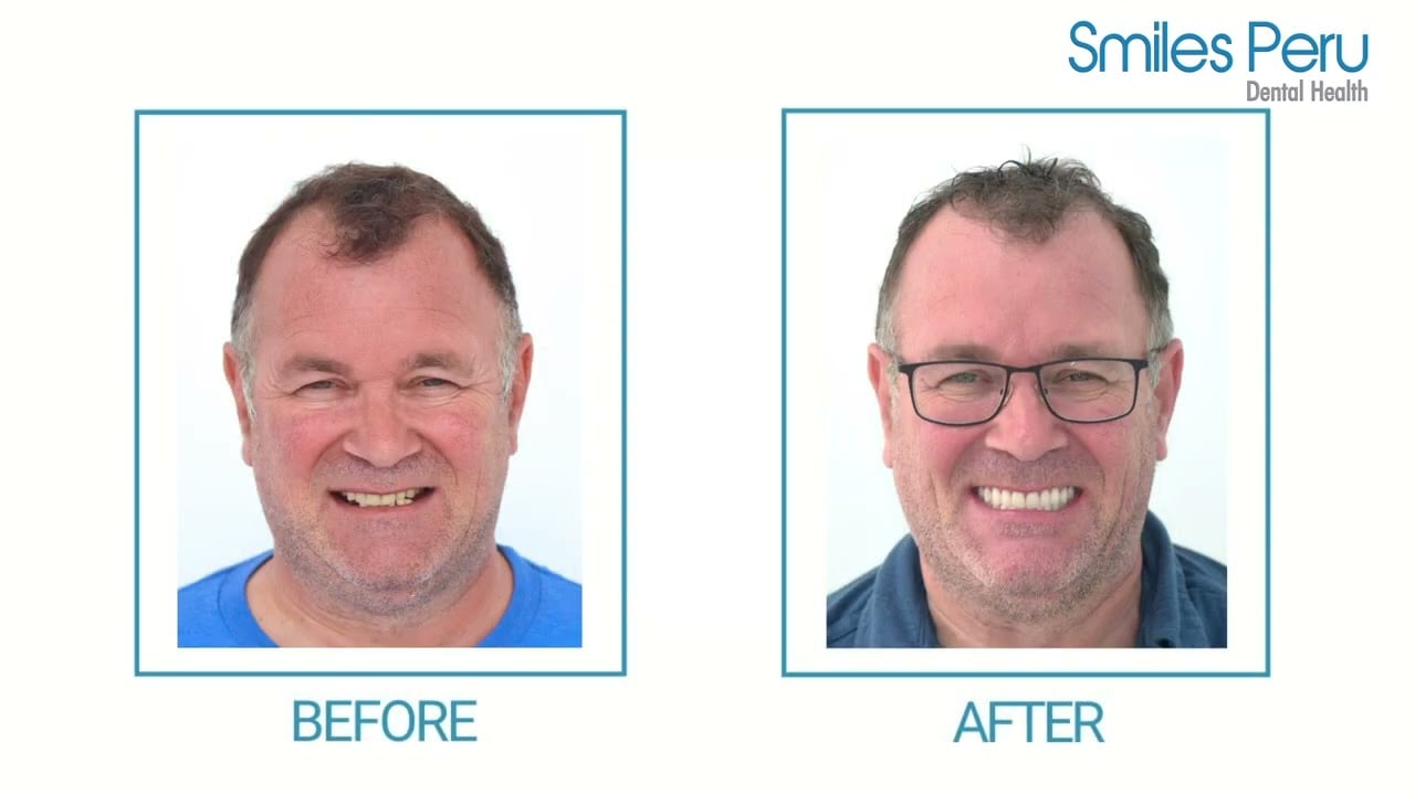 James Lowdell Testimonial | Smiles Peru