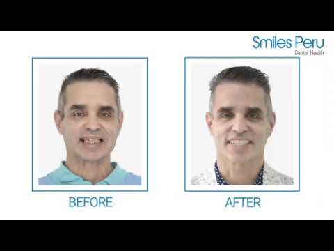 Smiles Peru : Video Testimonial Full Mouth Dental Implants with Zirconia Bridge