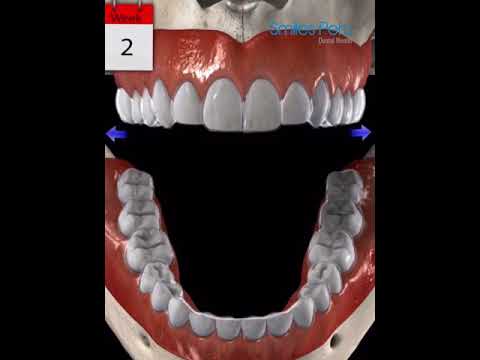 Invisalign Mordida Cruzada Posterior - Smiles Peru