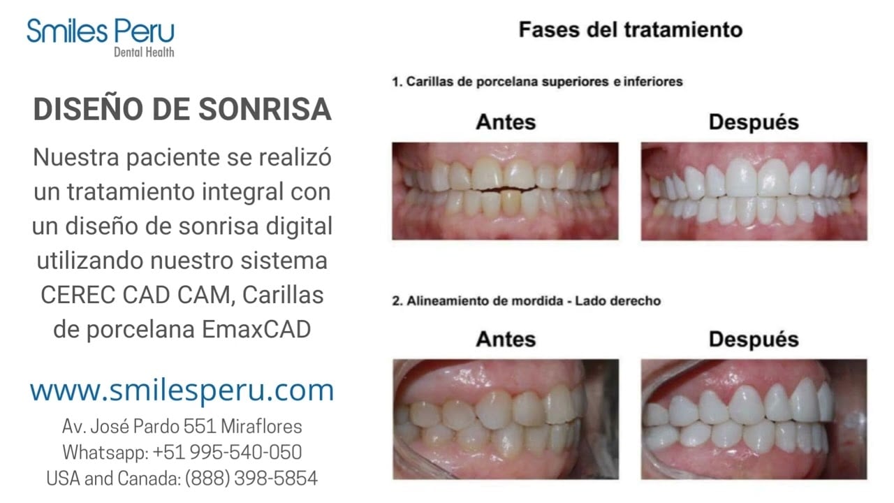 Smiles Peru:  Diseño de Sonrisa Digital CEREC CAD CAM