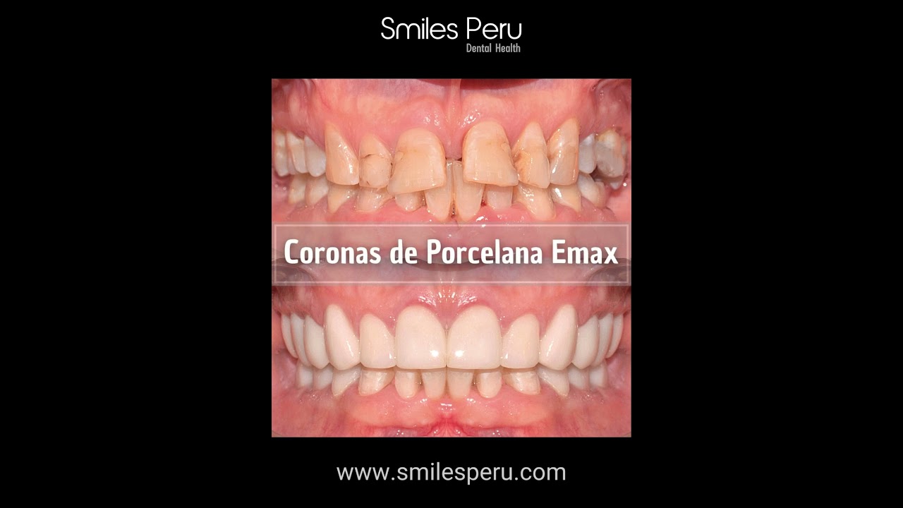 Diseño de Sonrisa en Smiles Peru - Paciente Jeffrey