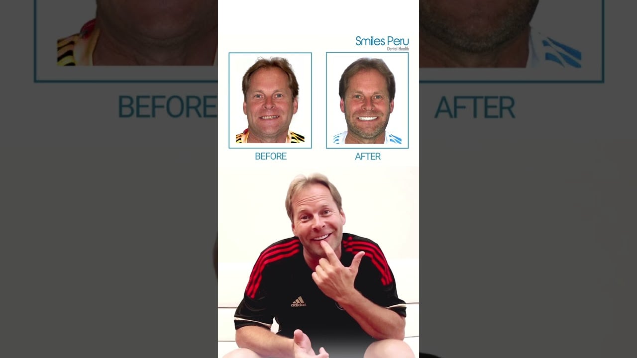 John’s Smile Transformation at Smiles Peru ✨