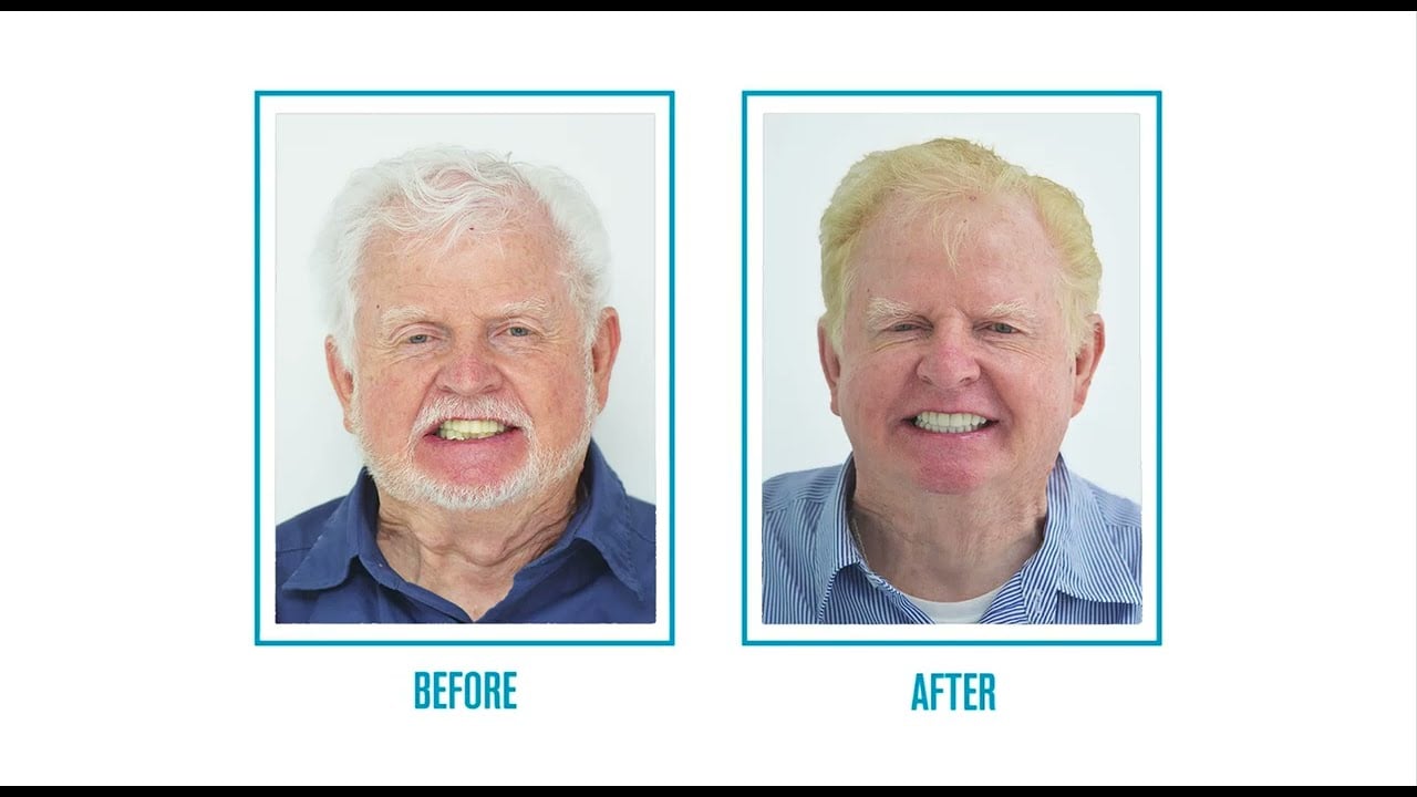 Smiles Peru Video Testimonial: Full Mouth Dental Implants with Full Arch Zirconia Bridge