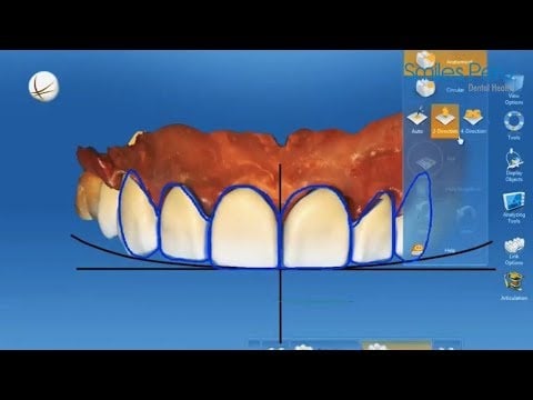 Porcelain Crowns | Smiles Peru | Coronas de Porcelana