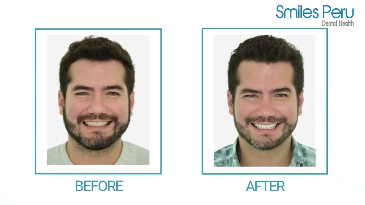 Smiles Peru: Porcelain Veneers Testimonial