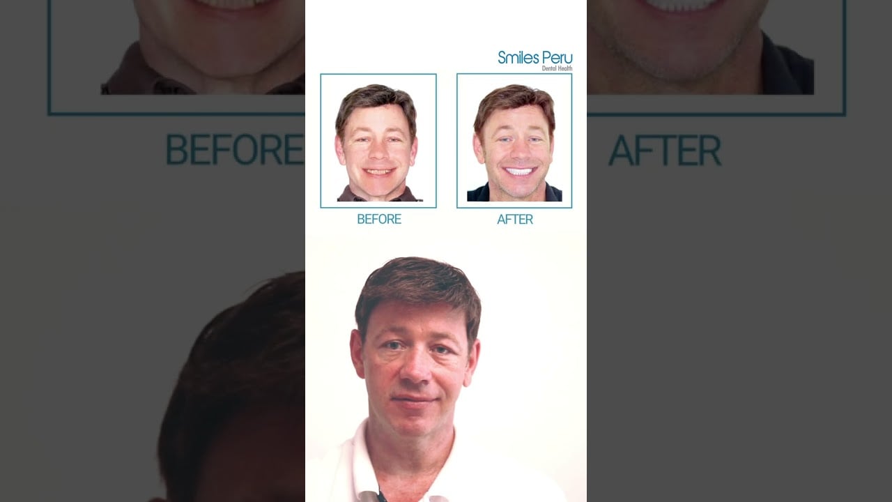 Patient Testimonial – Joseph | Smiles Peru