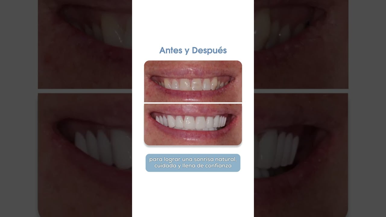 ¿Perdiste tu sonrisa? Recupérala con un diseño de sonrisa en Smiles Peru