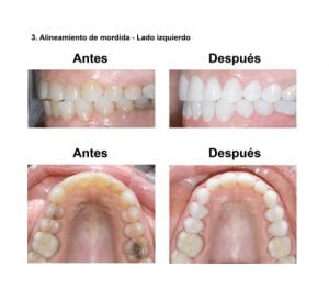 Smiles-Peru-Estetica-Dental-Caso-Clinico-5-300x263