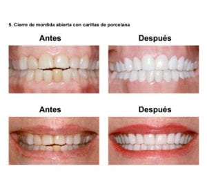 Smiles-Peru-Estetica-Dental-Caso-Clinico-7-300x263