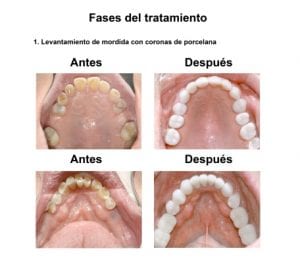 Smiles-Peru-Rehabilitacion-Oral-Caso-Clinico-4-300x263