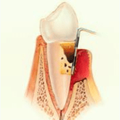 periodoncia-periodontitis-avanzada-3