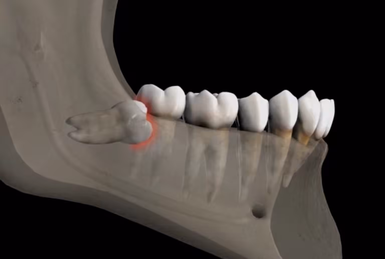 3rd molar wisdom tooth resorption Smiles Peru 3rd molar wisdom tooth resorption Smiles Peru