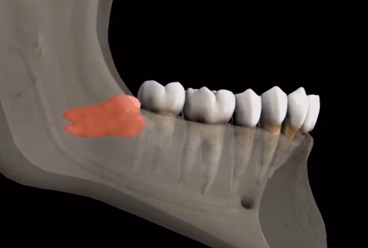 Smiles Peru wisdom tooth molar crowding Smiles Peru wisdom tooth molar crowding