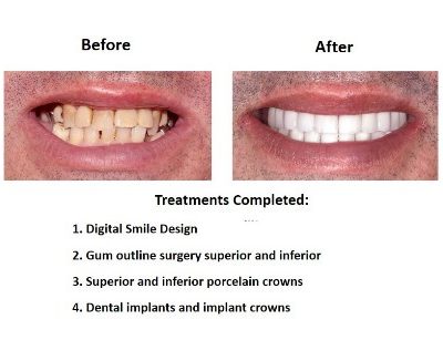 Smiles Peru Oral Rehabilitation (3)