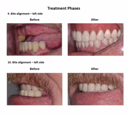 All on Eight Dental Implants Smiles Peru (1)