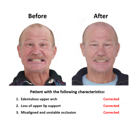 All on Eight Dental Implants Smiles Peru (2)