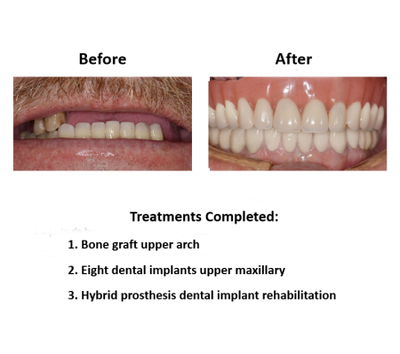 All on Eight Dental Implants Smiles Peru (3)
