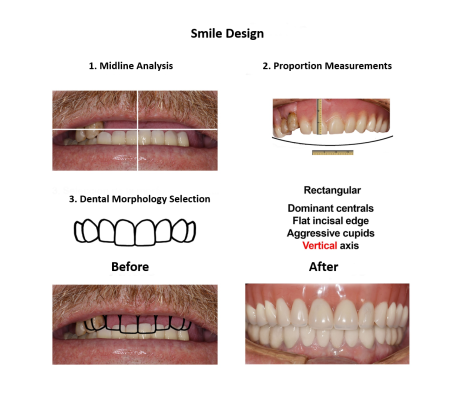 All on Eight Dental Implants Smiles Peru (4)