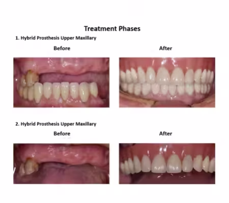 All on Eight Dental Implants Smiles Peru (5)