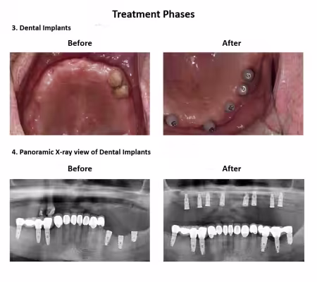 All on Eight Dental Implants Smiles Peru (6)
