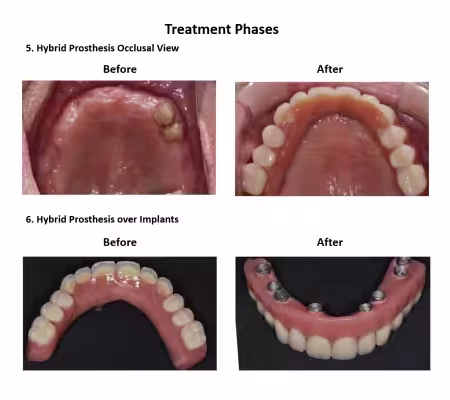 All on Eight Dental Implants Smiles Peru (7)