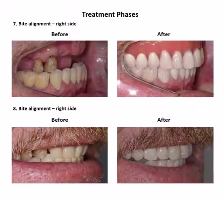 All on Eight Dental Implants Smiles Peru (8)