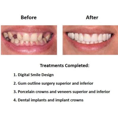 Dental-Implants-Case-Study-Smiles-Peru-