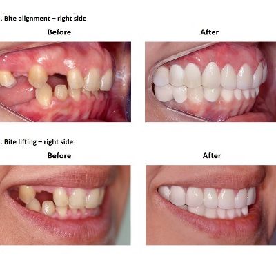 Dental-Implants-Case-Study-Smiles-Peru
