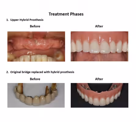 Dental implant supported prosthesis Smiles Peru Dental Lima Dentist (4)