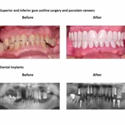 Oral-Rehabilitation-Smiles-Peru-Case-Study