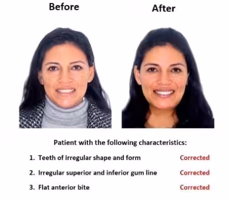 Porcelain-Veneers-Smiles-Peru-Case-Study-1 Porcelain-Veneers-Smiles-Peru-Case-Study