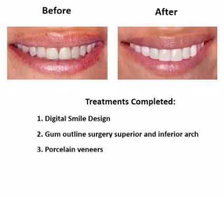 Porcelain-Veneers-Smiles-Peru-Case-Study-2 Porcelain-Veneers-Smiles-Peru-Case-Study