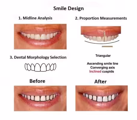 Porcelain-Veneers-Smiles-Peru-Case-Study-3 Porcelain-Veneers-Smiles-Peru-Case-Study