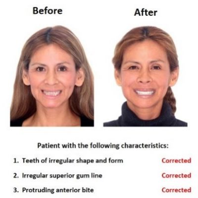 Smile-Design-Lima-Dentist-Smiles-Peru-1