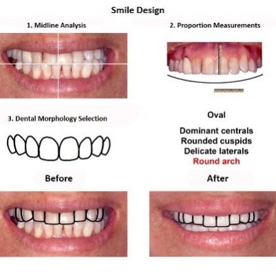 Smile-Design-Lima-Dentist-Smiles-Peru-2